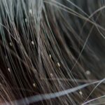 Cara Menghilangkan Kutu Rambut dan Telurnya Dalam 1 Hari