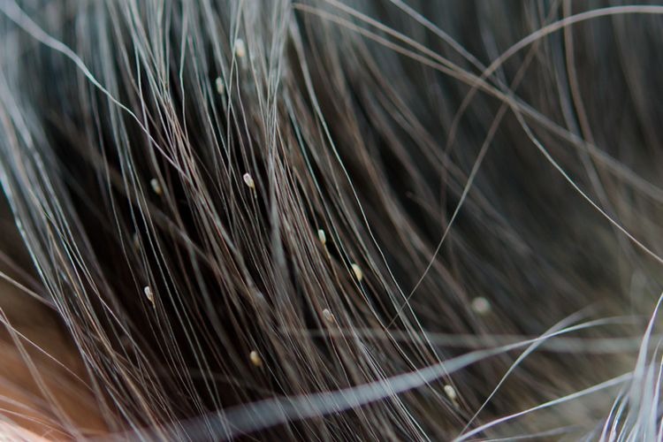 Cara Menghilangkan Kutu Rambut dan Telurnya Dalam 1 Hari