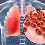 ASI Eksklusif dapat Mencegah Penyakit Pneumonia