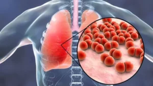 ASI Eksklusif dapat Mencegah Penyakit Pneumonia