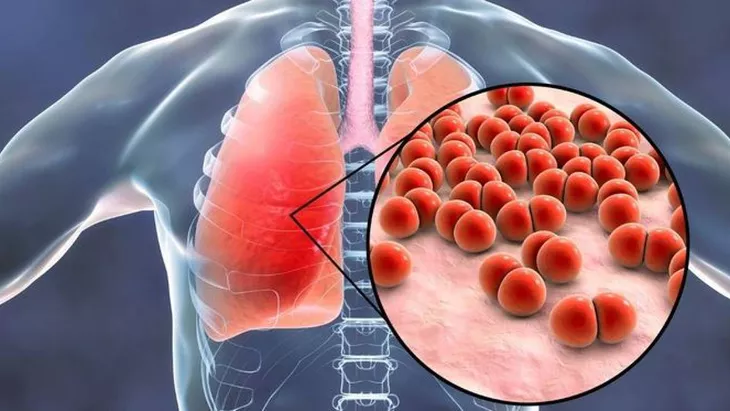 ASI Eksklusif dapat Mencegah Penyakit Pneumonia
